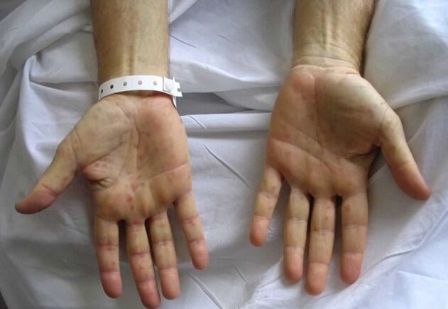 szifilisz a kézen, mint a pénisz kóros váladékozásának oka